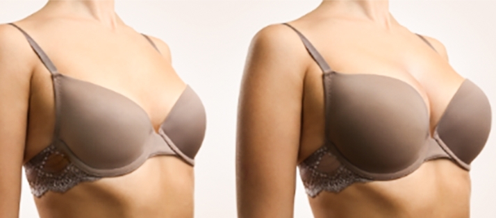 Breast Augmentation