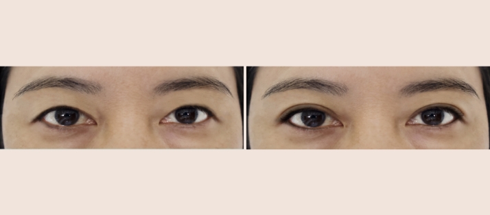 BLEPHAROPLASTY (eyelid surgery)