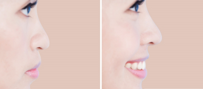 Rhinoplasty